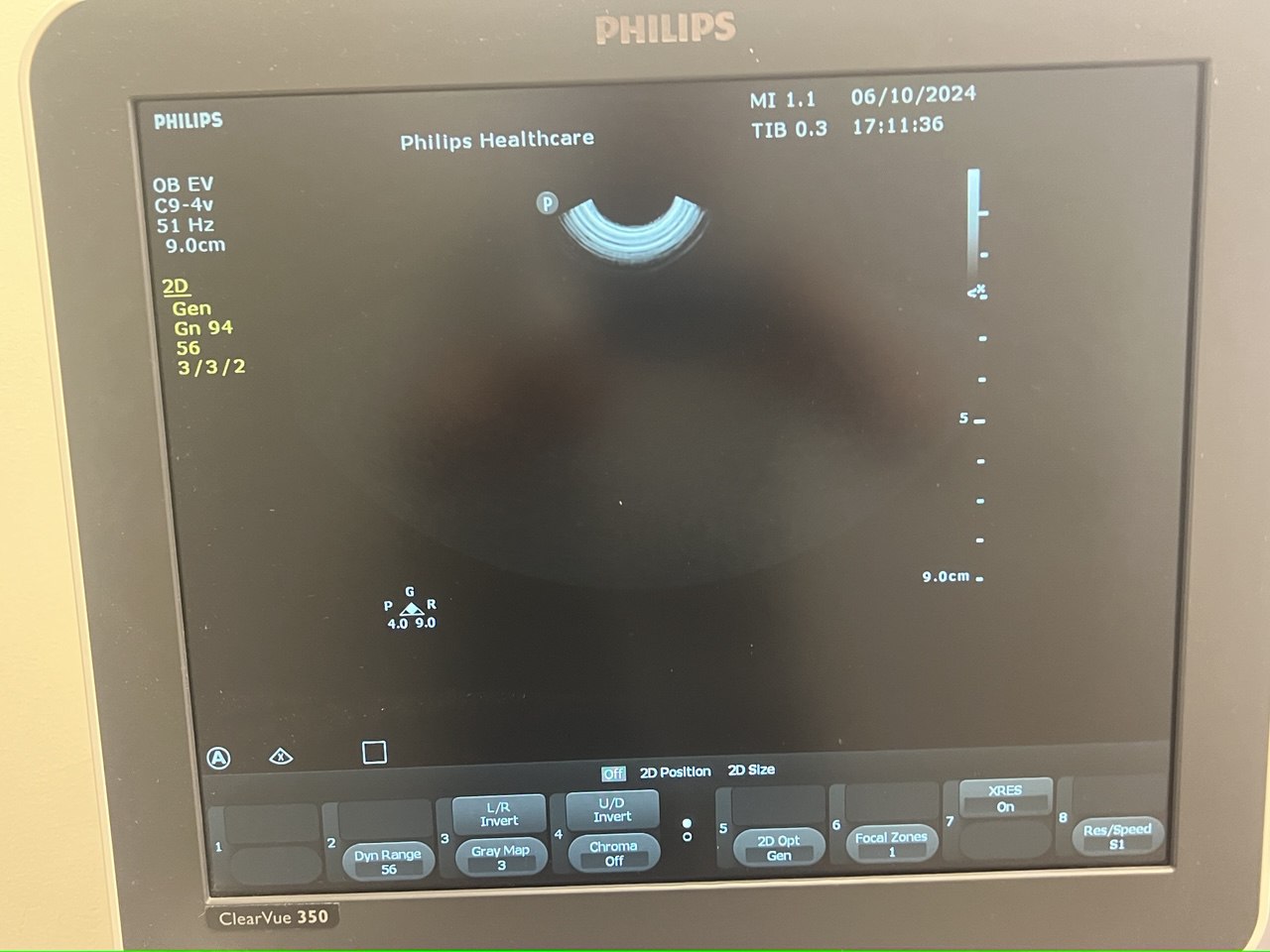 מכשיר אולטרסאונד PHILIPS