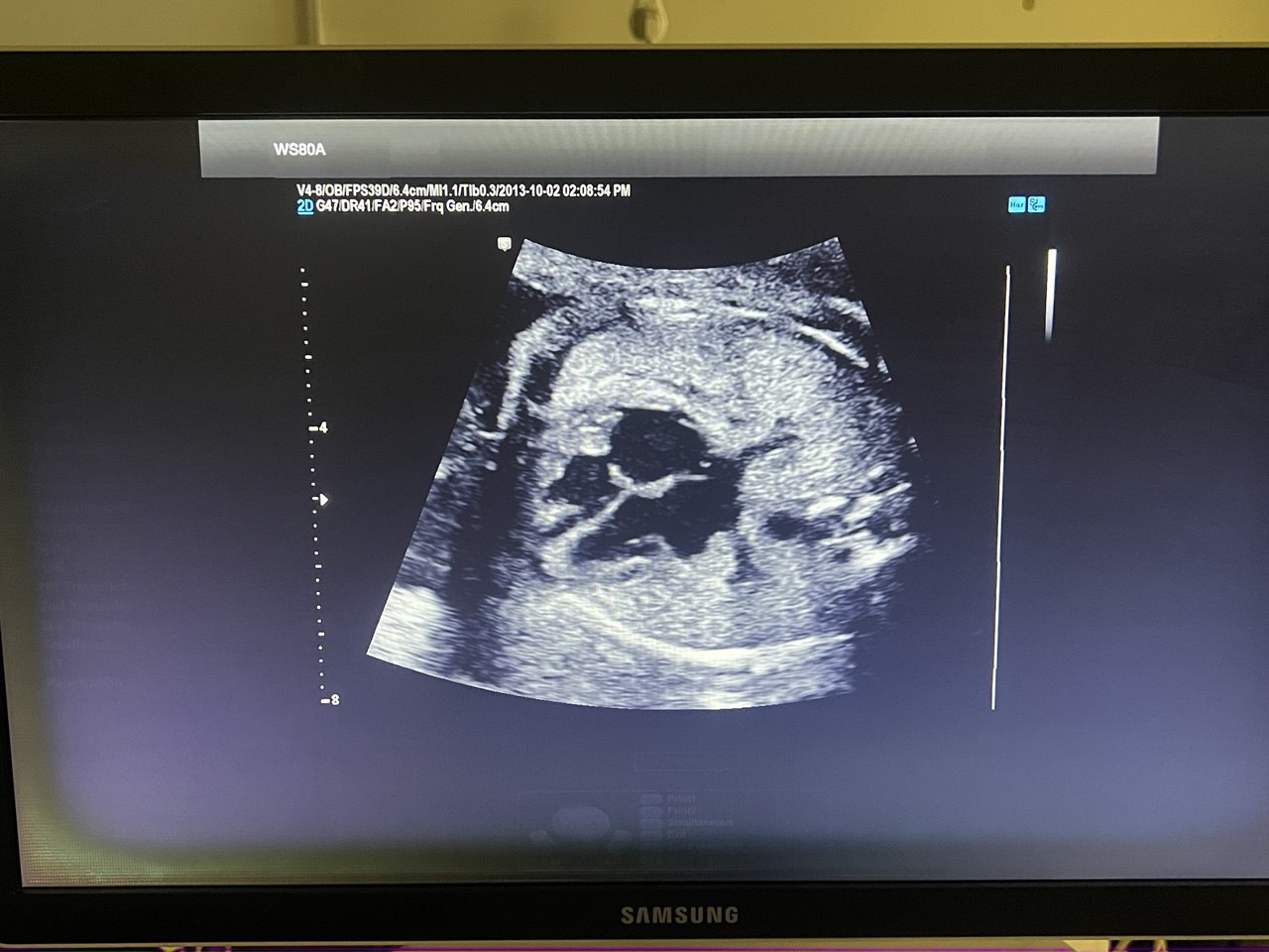 מכשיר אולטרסאונד משומש