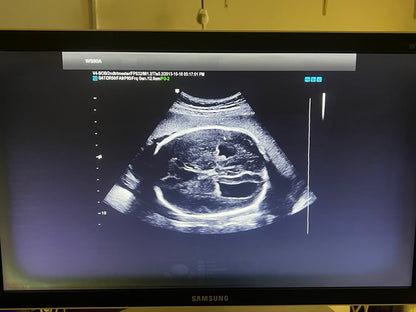 Ultrasound used